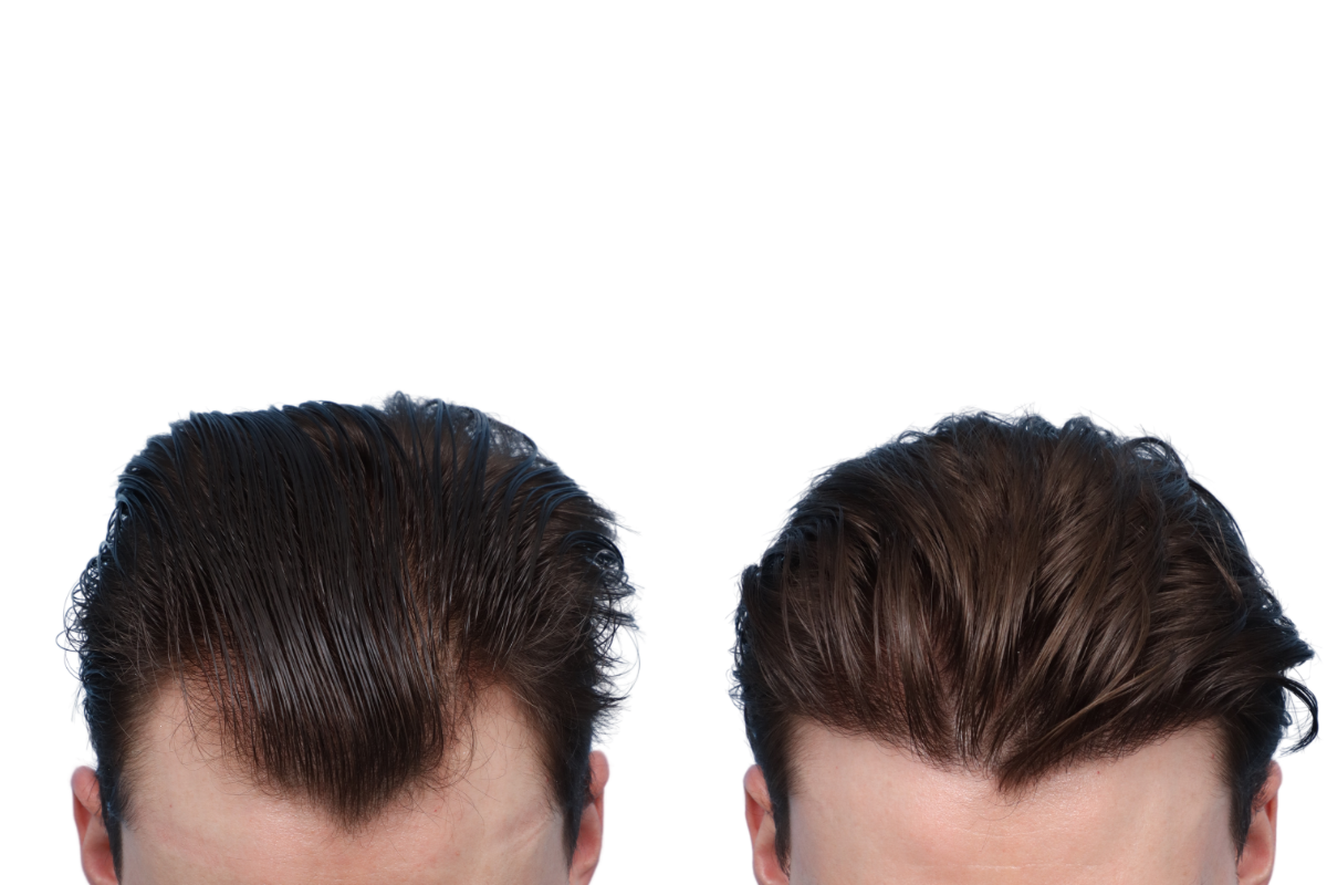 FUE Hair Transplant Before & After Gallery - Patient 18736 - Image 1