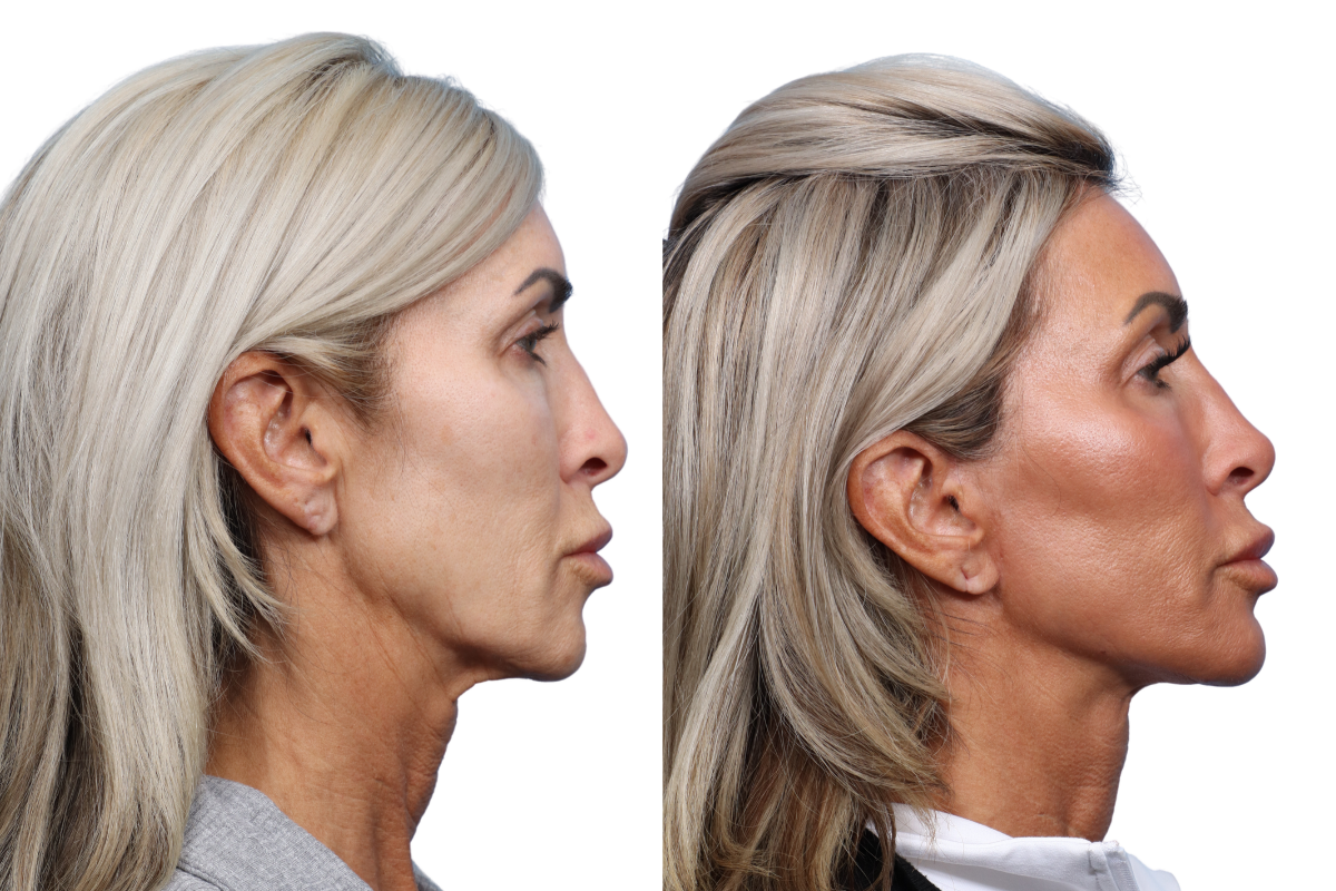 Facelift Before & After Gallery - Patient 6336 - Image 2