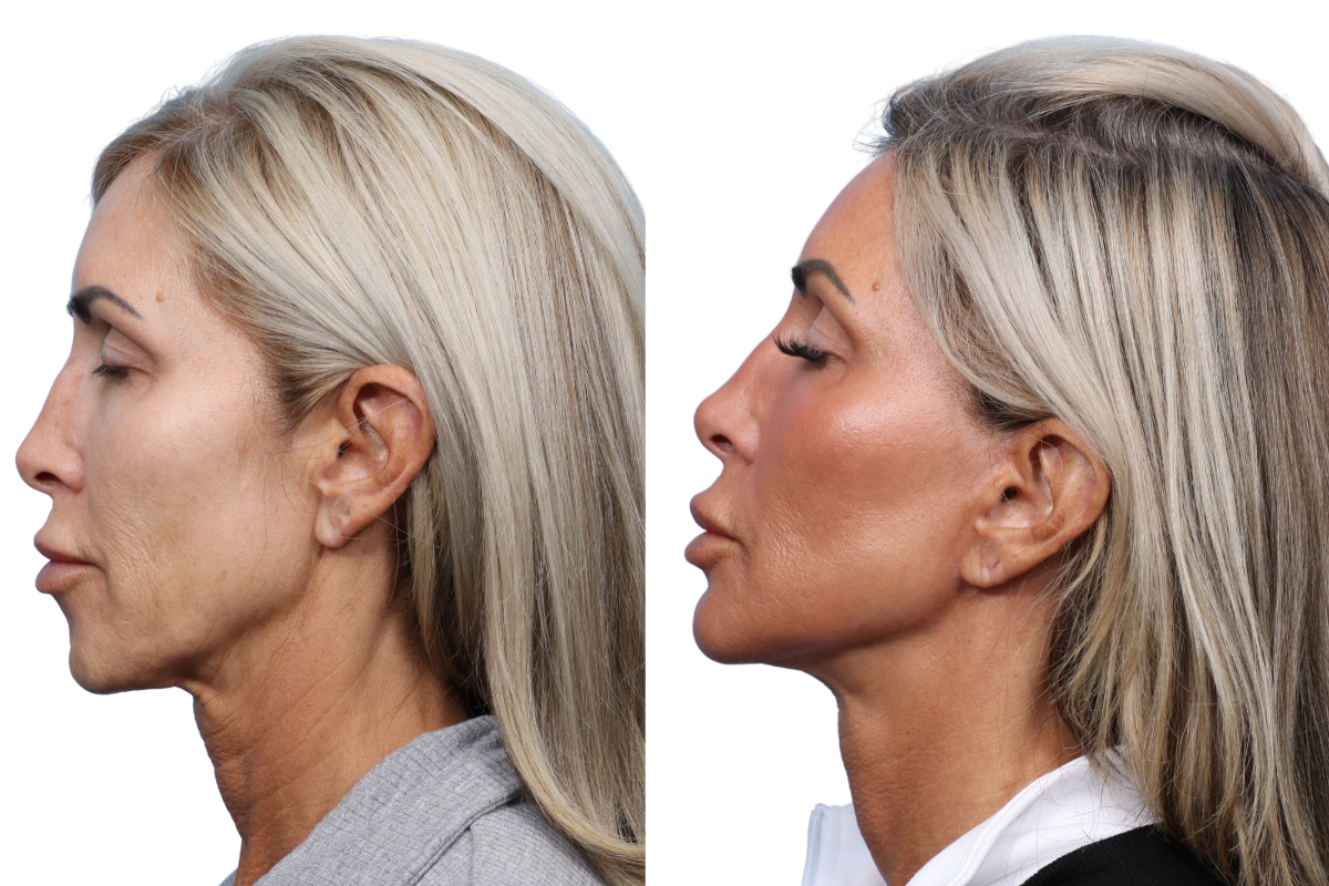 Facelift Before & After Gallery - Patient 6336 - Image 3
