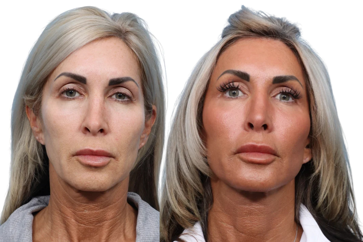 Facelift Before & After Gallery - Patient 6336 - Image 1