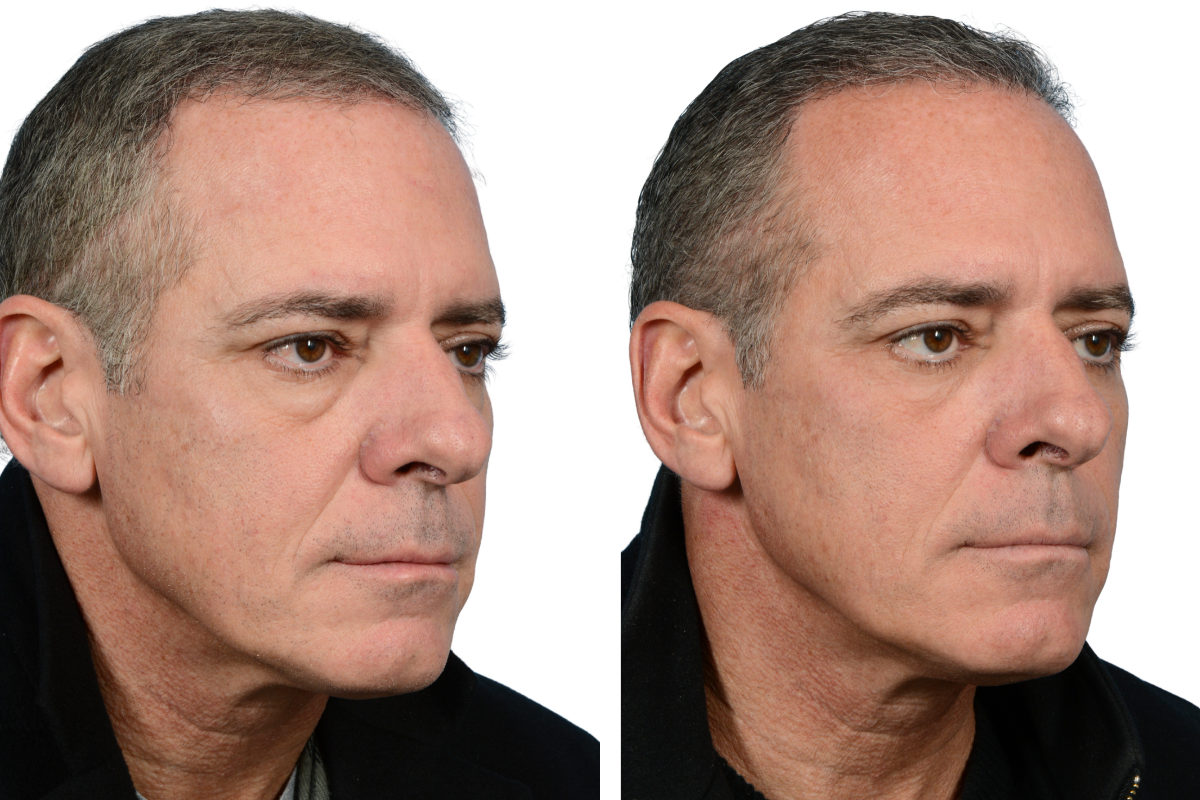Blepharoplasty (Eyelid Surgery) Before & After Gallery - Patient 7684 - Image 2