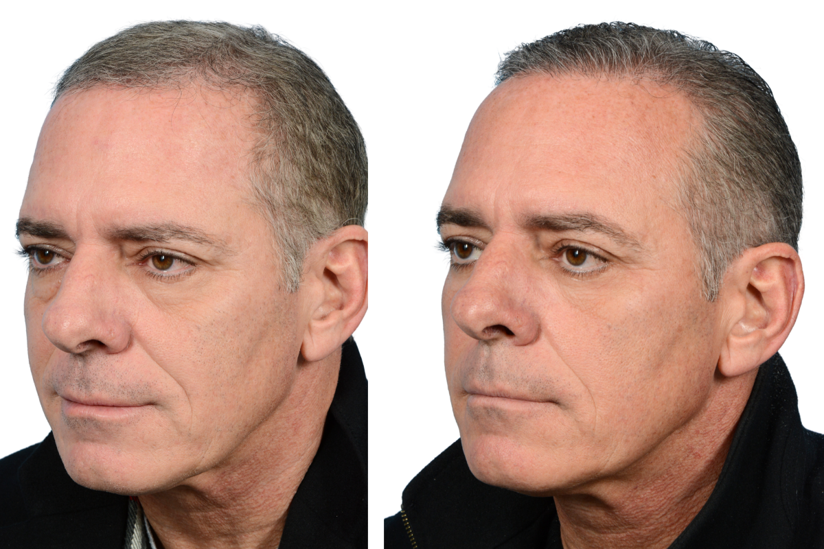 Blepharoplasty (Eyelid Surgery) Before & After Gallery - Patient 7684 - Image 3