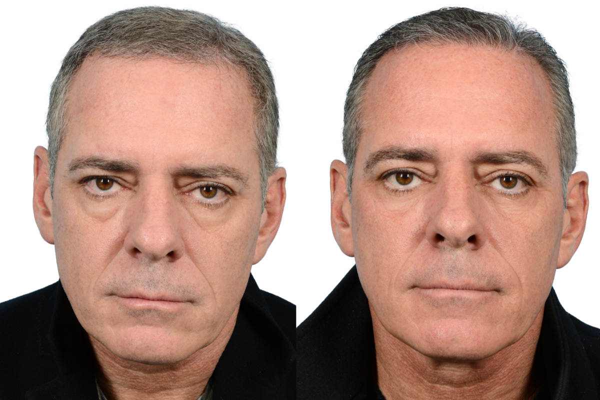 Blepharoplasty (Eyelid Surgery) Before & After Gallery - Patient 7684 - Image 1