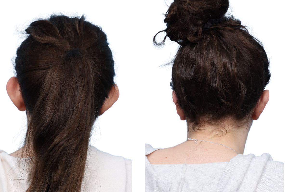 Otoplasty (Ear Surgery) Before & After Gallery - Patient 66277 - Image 1