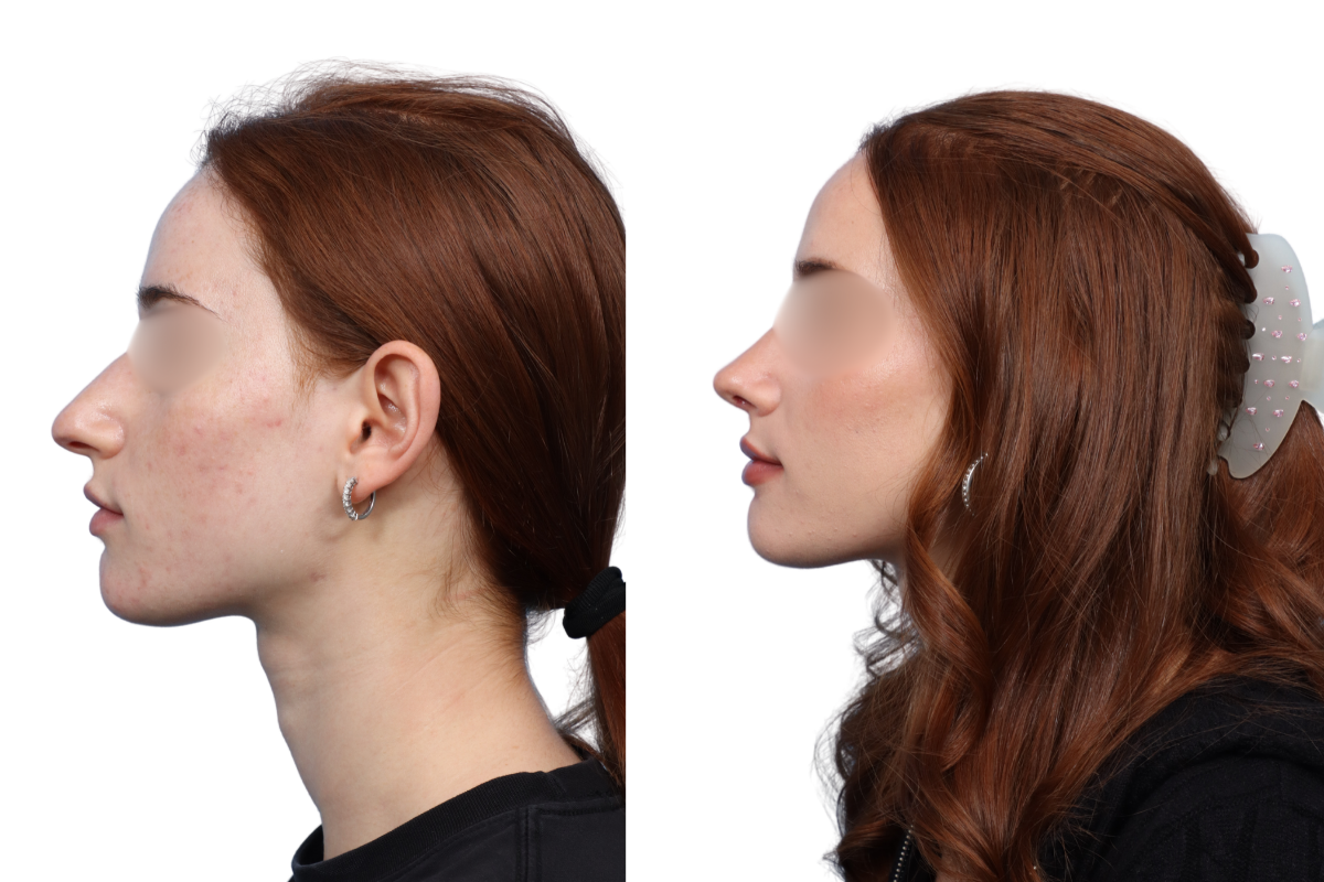 Rhinoplasty Before & After Gallery - Patient 67165 - Image 1
