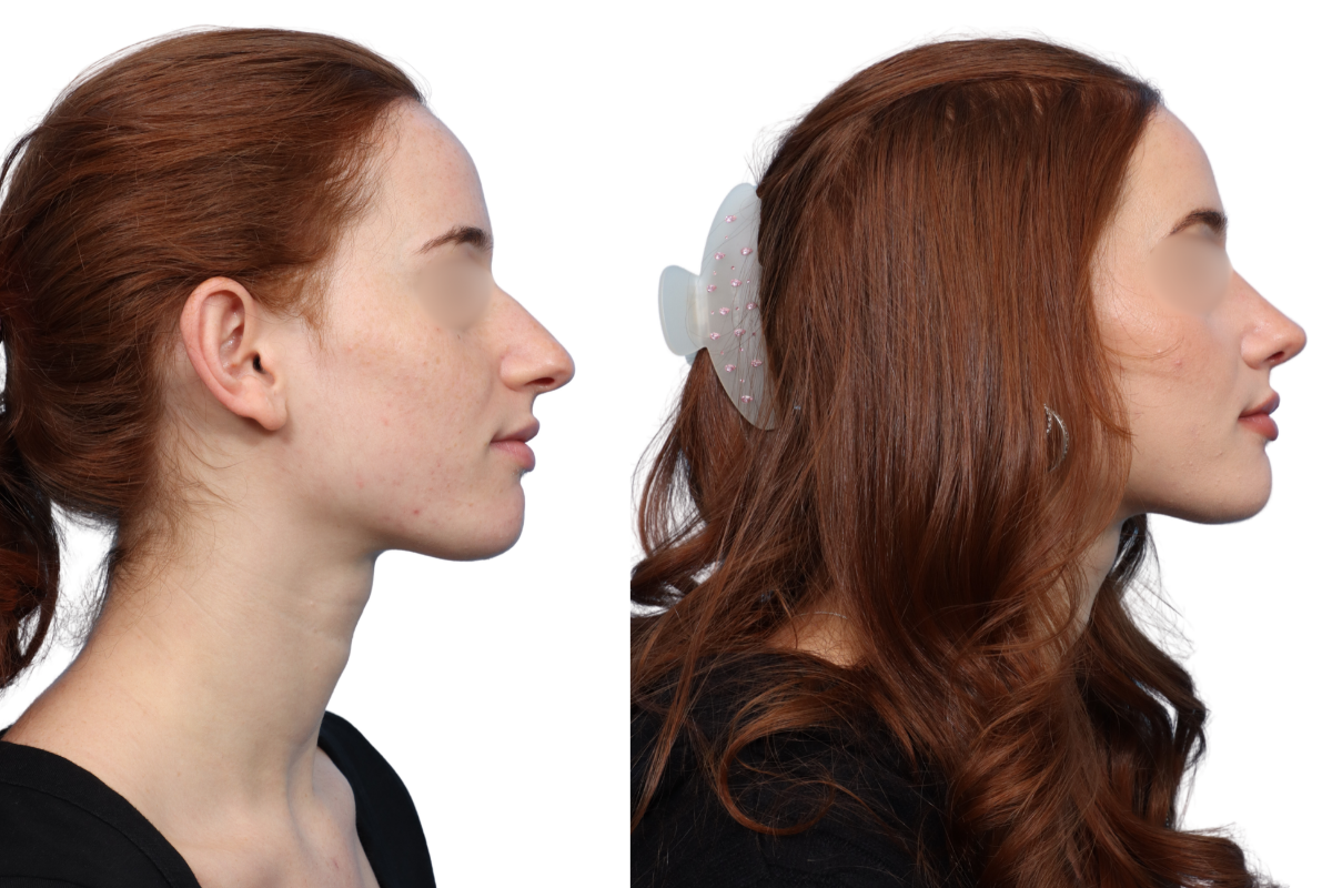 Rhinoplasty Before & After Gallery - Patient 67165 - Image 2