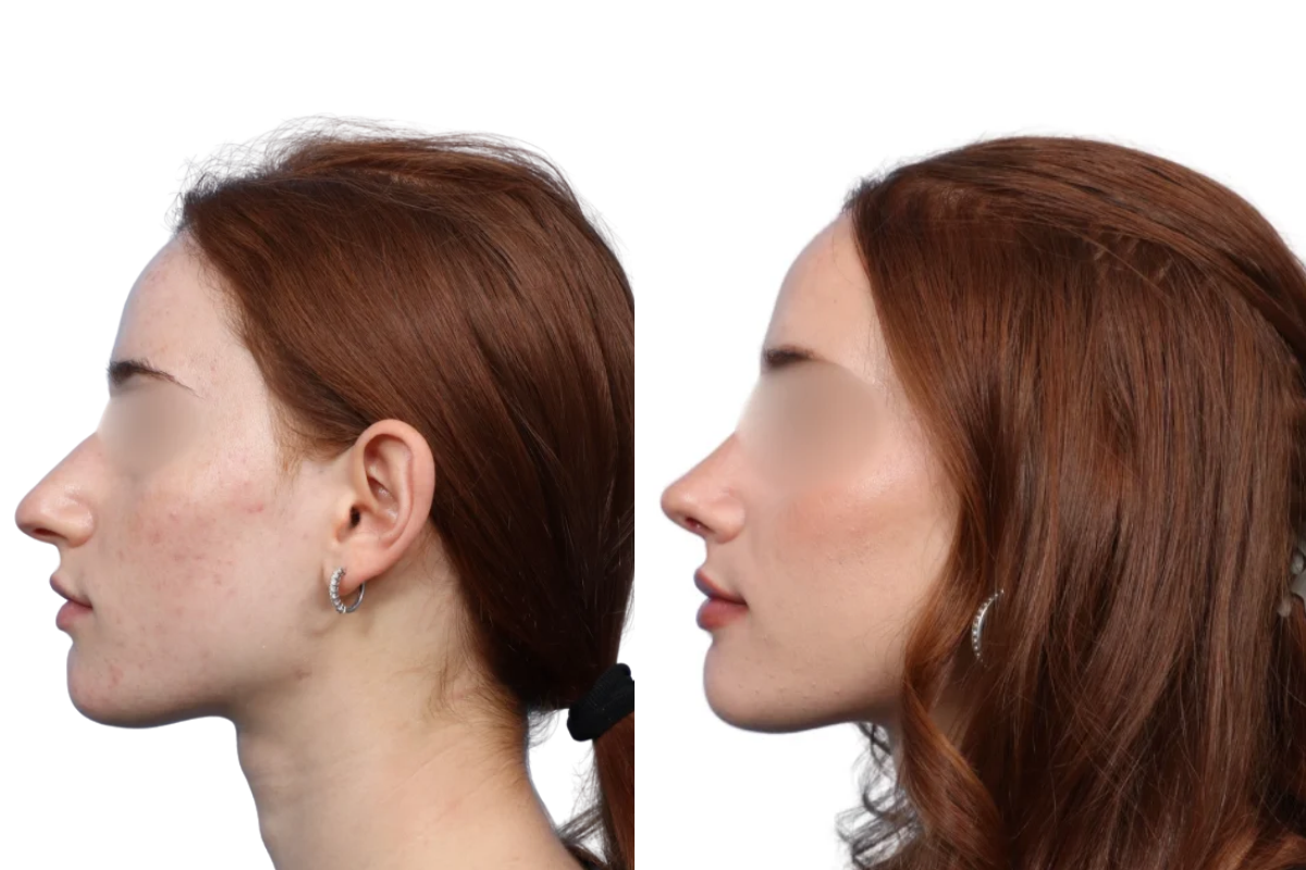 Rhinoplasty Before & After Gallery - Patient 67165 - Image 1