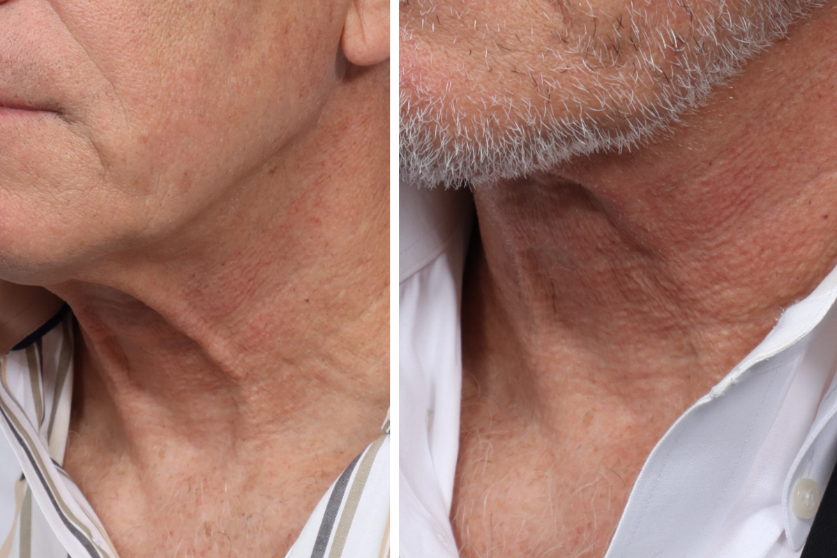 Submentoplasty Before & After Gallery - Patient 7684 - Image 7
