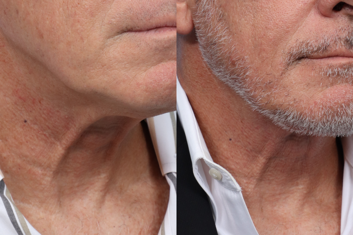 Submentoplasty Before & After Gallery - Patient 7684 - Image 6
