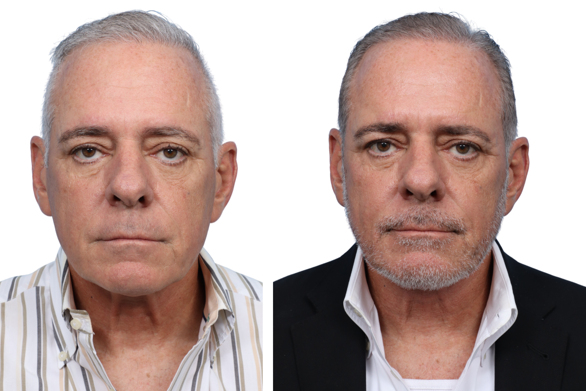 Submentoplasty Before & After Gallery - Patient 7684 - Image 2