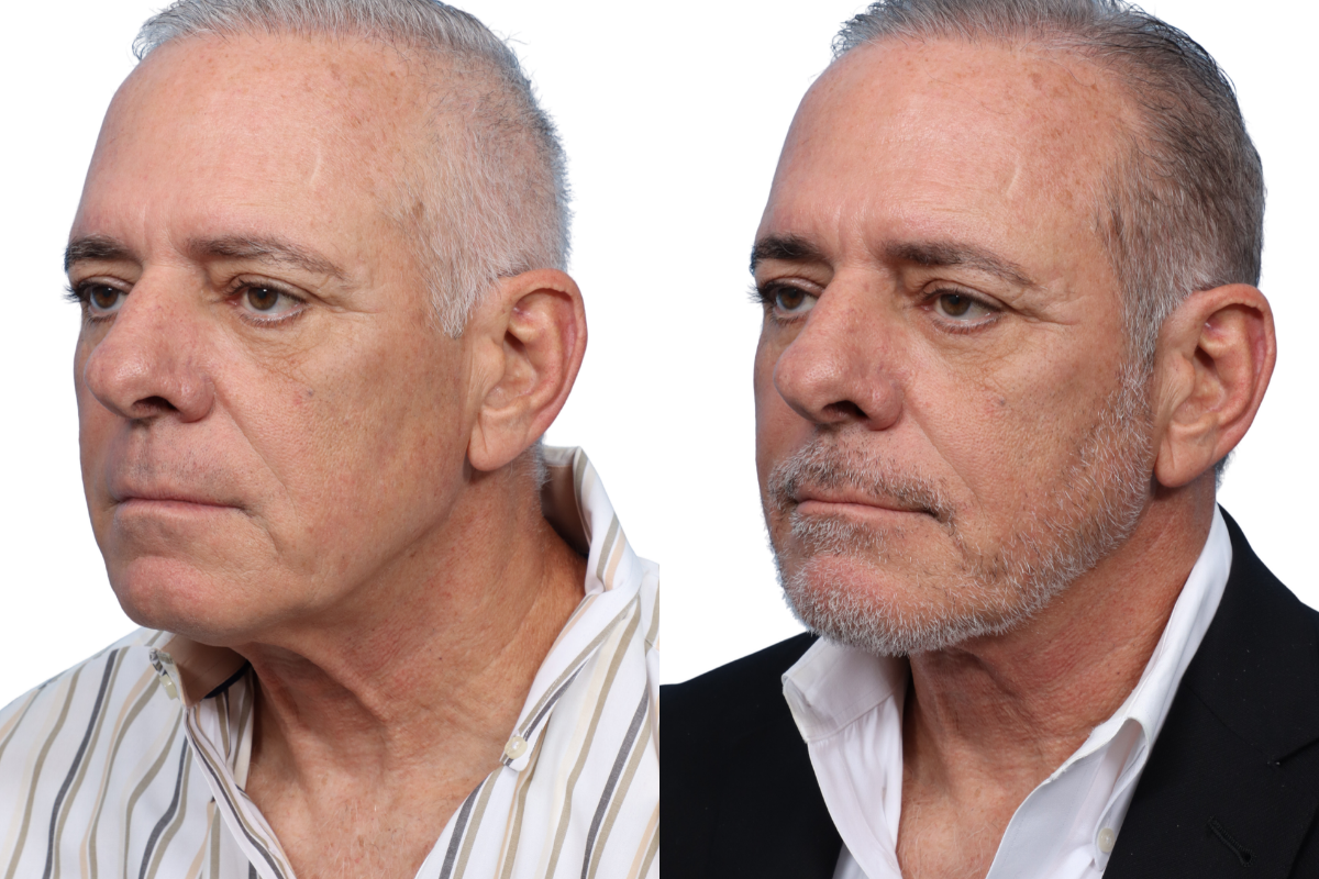 Submentoplasty Before & After Gallery - Patient 7684 - Image 3
