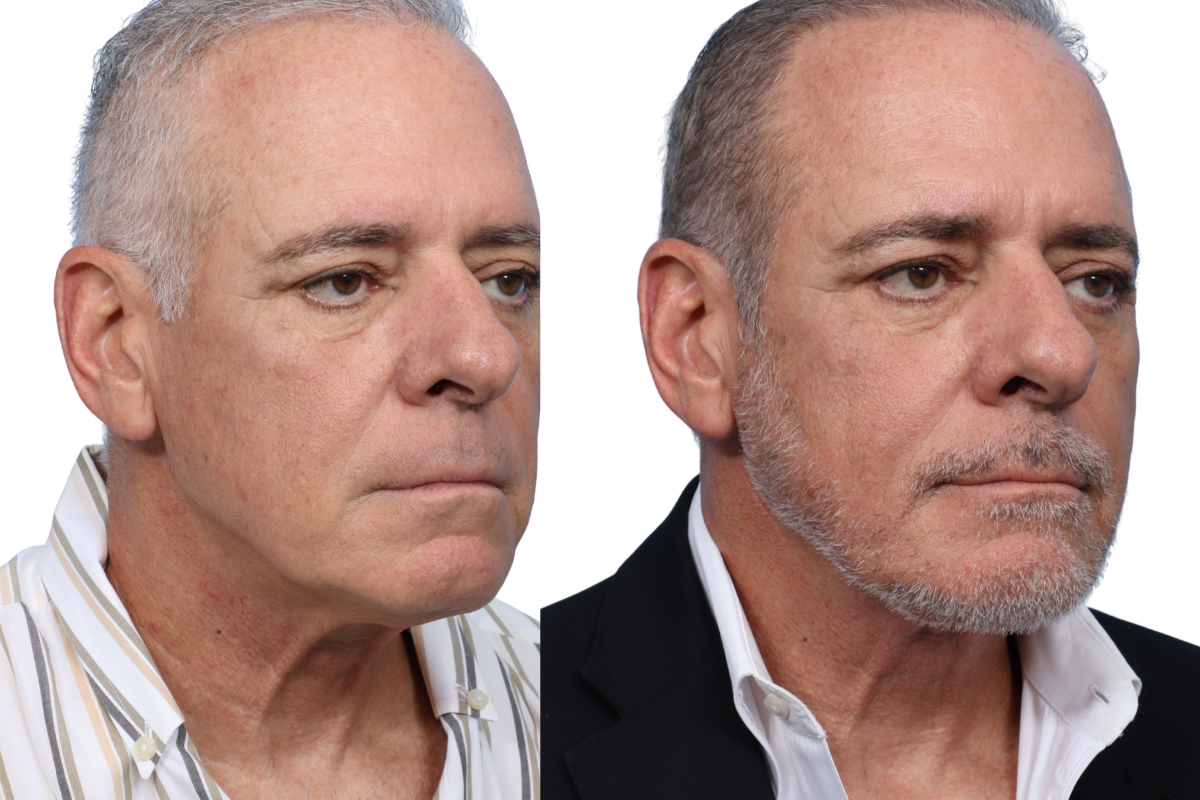 Submentoplasty Before & After Gallery - Patient 7684 - Image 1
