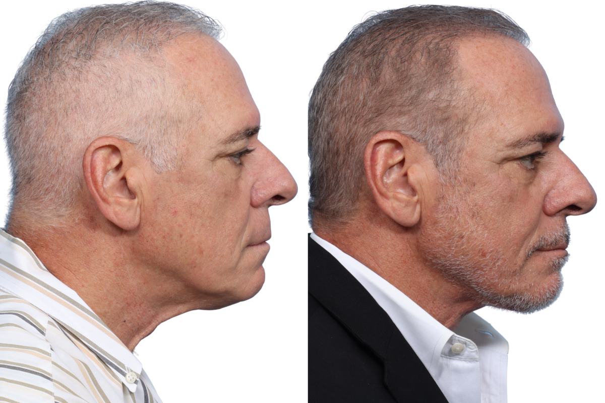 Submentoplasty Before & After Gallery - Patient 7684 - Image 4