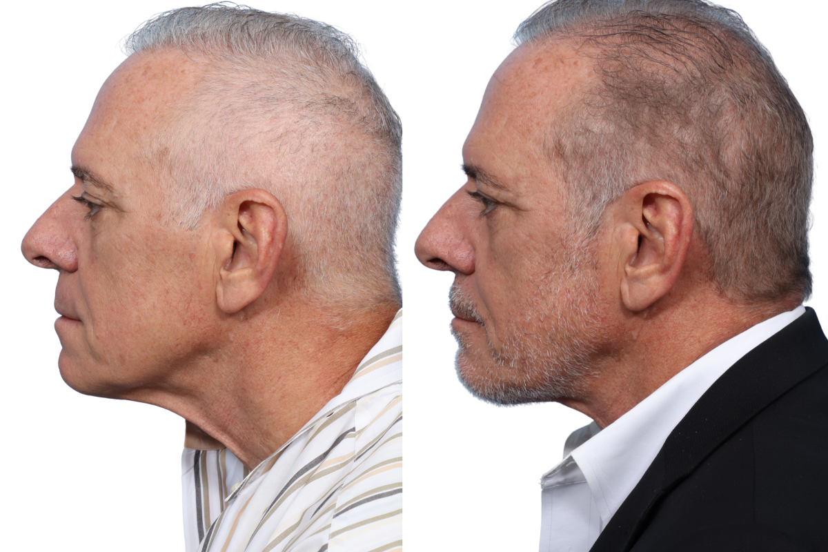 Submentoplasty Before & After Gallery - Patient 7684 - Image 5
