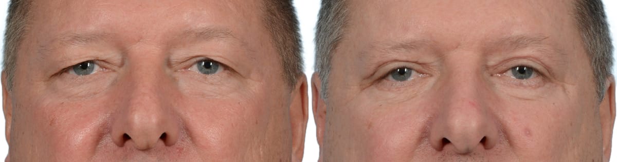 Blepharoplasty (Eyelid Surgery) Before & After Gallery - Patient 378899 - Image 1