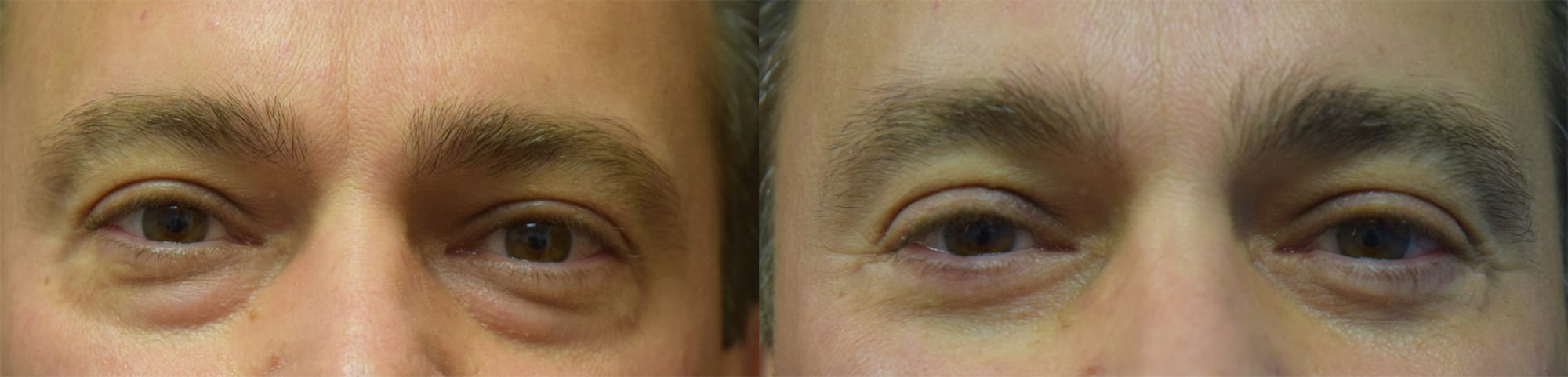 Blepharoplasty (Eyelid Surgery) Before & After Gallery - Patient 375645 - Image 1
