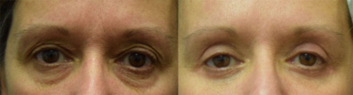 Blepharoplasty (Eyelid Surgery) Before & After Gallery - Patient 412459 - Image 1