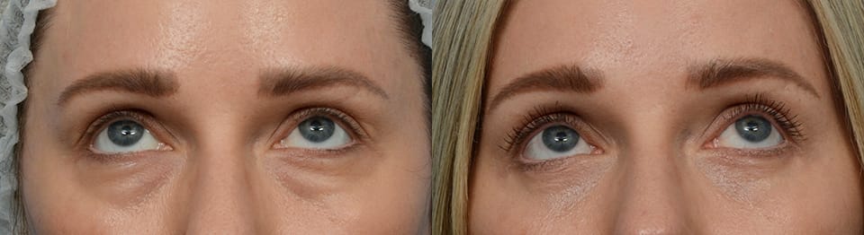 Blepharoplasty (Eyelid Surgery) Before & After Gallery - Patient 299794 - Image 1