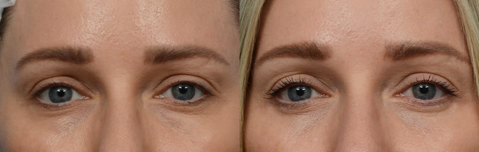 Blepharoplasty (Eyelid Surgery) Before & After Gallery - Patient 299794 - Image 2