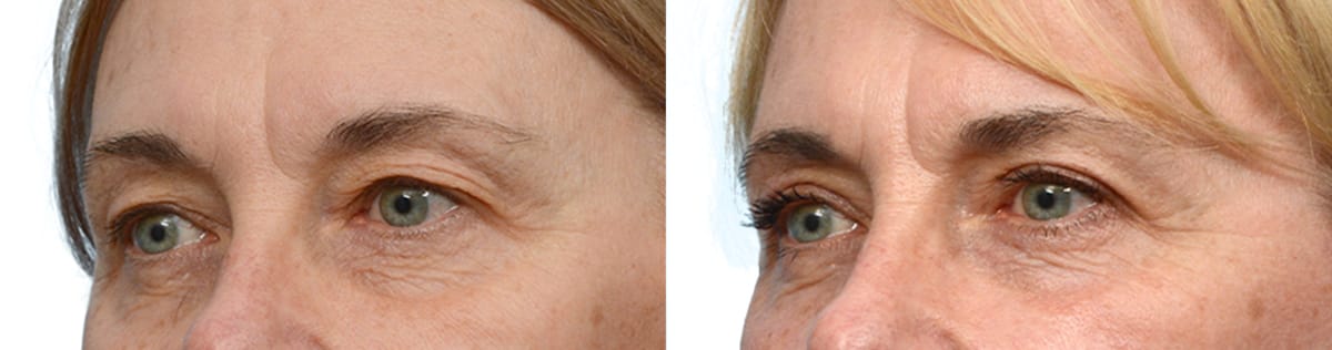 Blepharoplasty (Eyelid Surgery) Before & After Gallery - Patient 169649 - Image 2