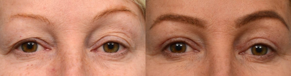 Blepharoplasty (Eyelid Surgery) Before & After Gallery - Patient 254816 - Image 1