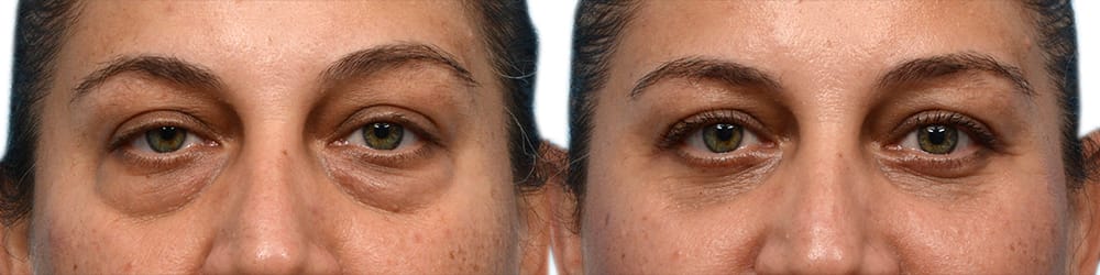 Blepharoplasty (Eyelid Surgery) Before & After Gallery - Patient 571323 - Image 1