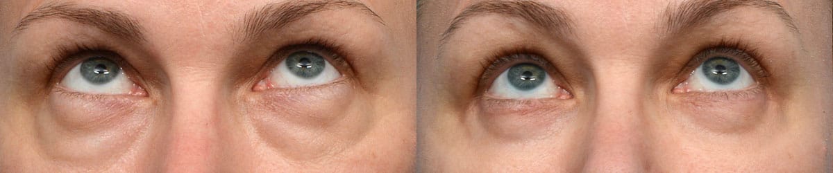 Blepharoplasty (Eyelid Surgery) Before & After Gallery - Patient 316159 - Image 2