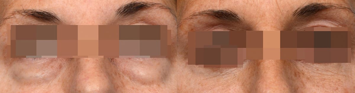 Blepharoplasty (Eyelid Surgery) Before & After Gallery - Patient 254883 - Image 2