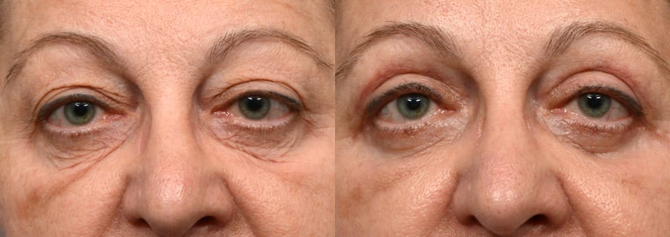 Blepharoplasty (Eyelid Surgery) Before & After Gallery - Patient 973569 - Image 1