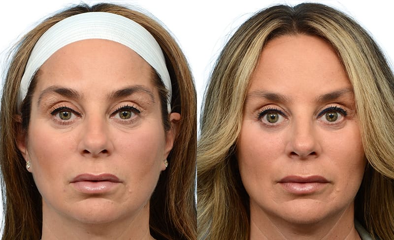 Blepharoplasty (Eyelid Surgery) Before & After Gallery - Patient 128270 - Image 1