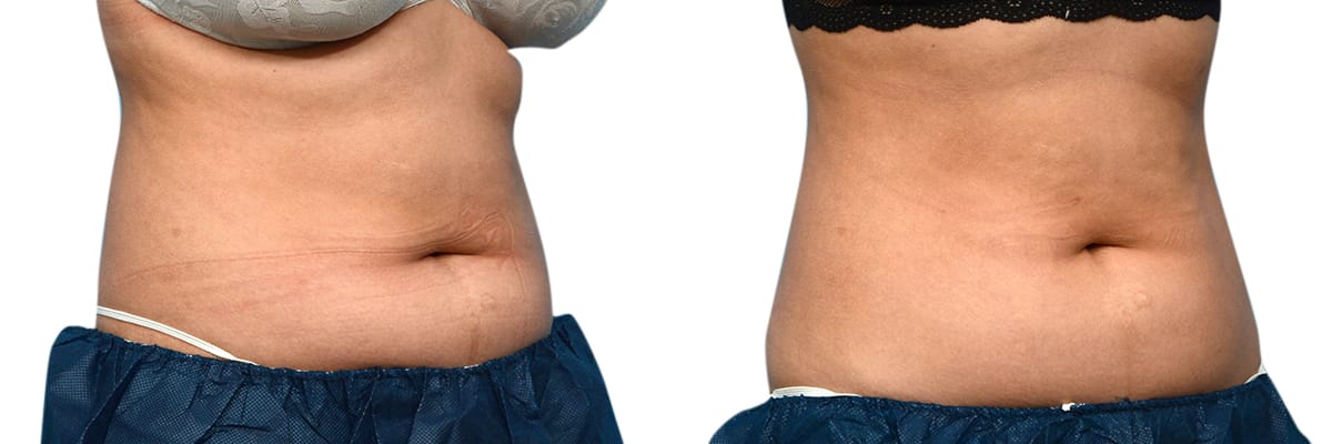 CoolSculpting® Before & After Gallery - Patient 308559 - Image 2