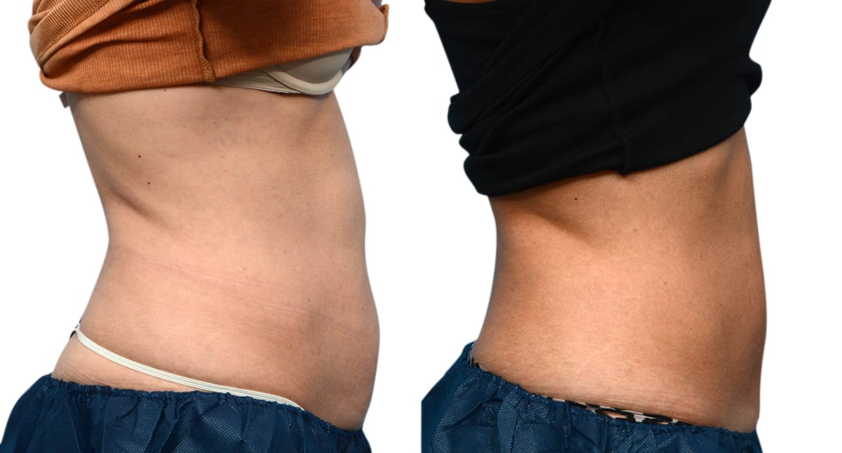 CoolSculpting® Before & After Gallery - Patient 279257 - Image 3