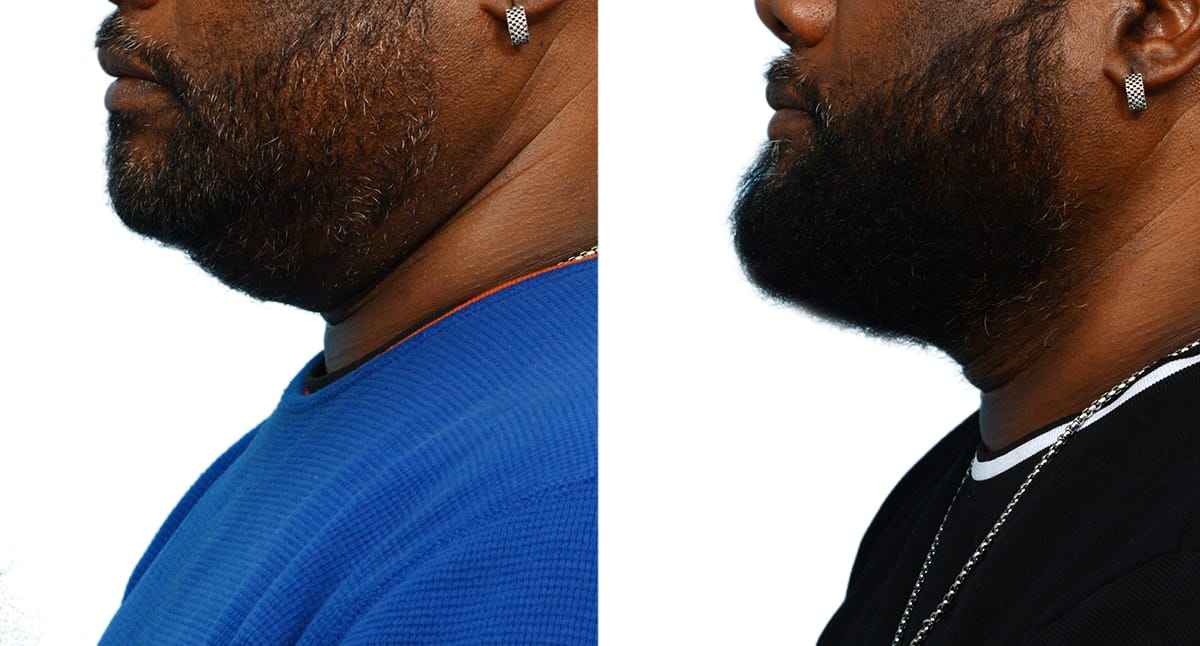 Chin Augmentation Before & After Gallery - Patient 176797 - Image 2