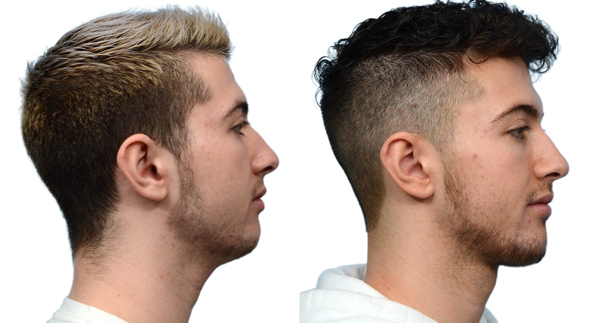 Chin Augmentation Before & After Gallery - Patient 399479 - Image 3