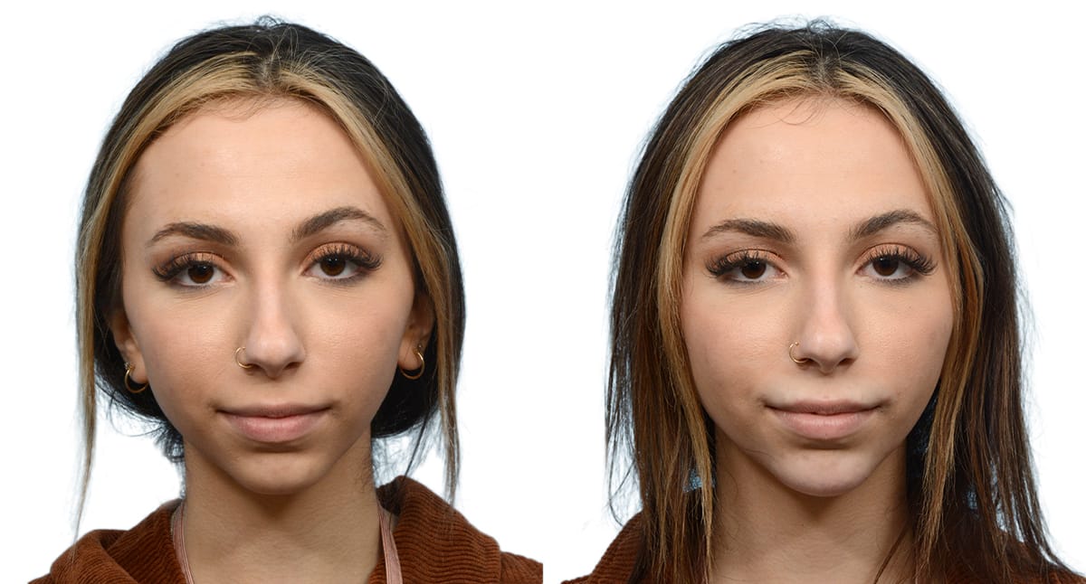 Chin Augmentation Before & After Gallery - Patient 422780 - Image 3