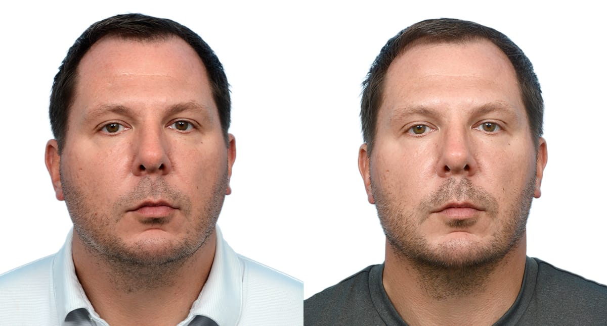 Chin Augmentation Before & After Gallery - Patient 281452 - Image 1