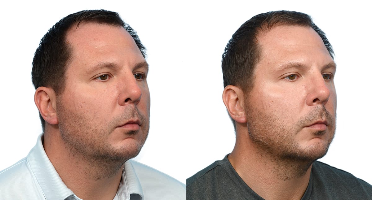 Chin Augmentation Before & After Gallery - Patient 281452 - Image 4