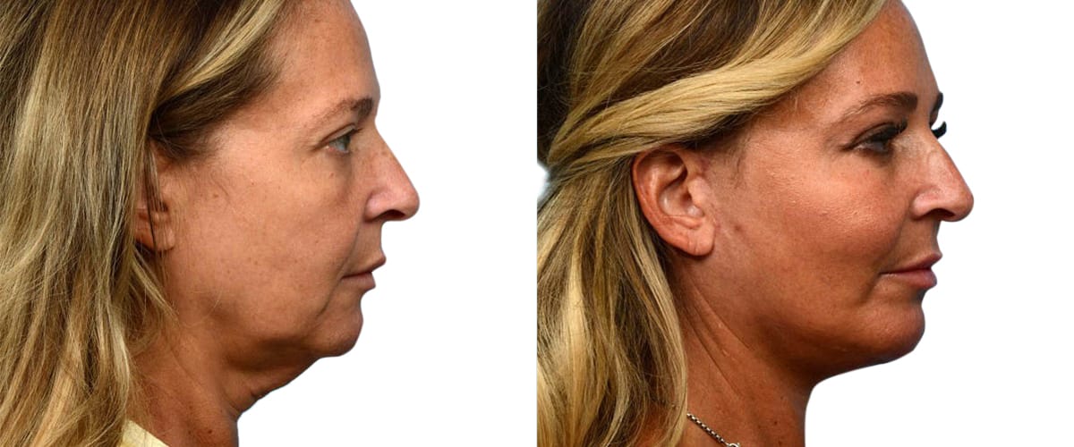 Chin Augmentation Before & After Gallery - Patient 195180 - Image 2