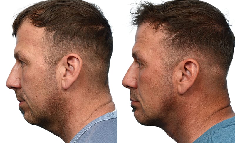Chin Augmentation Before & After Gallery - Patient 363843 - Image 3