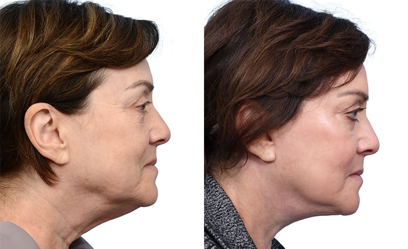 CO2 Laser before and after