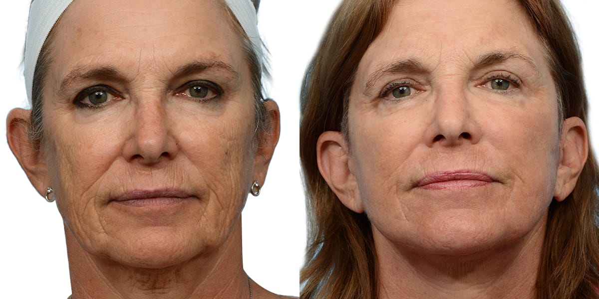 Deep Plane Facelift Before & After Gallery - Patient 515174 - Image 1
