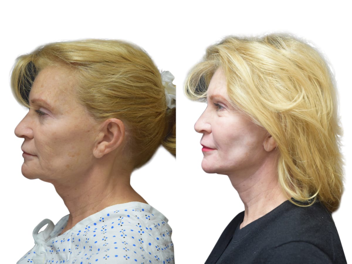 Facelift Before & After Gallery - Patient 111317 - Image 3