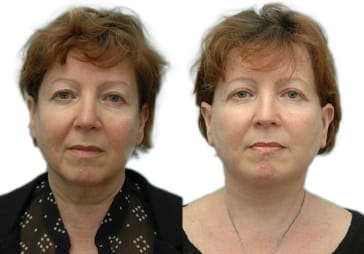 Facelift before and after