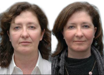 Facelift before and after