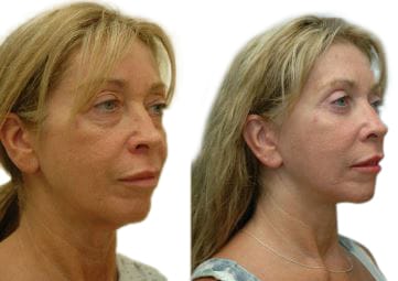 Facelift Before & After Gallery - Patient 117438 - Image 2
