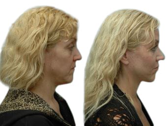 Facelift Before & After Gallery - Patient 127671 - Image 2