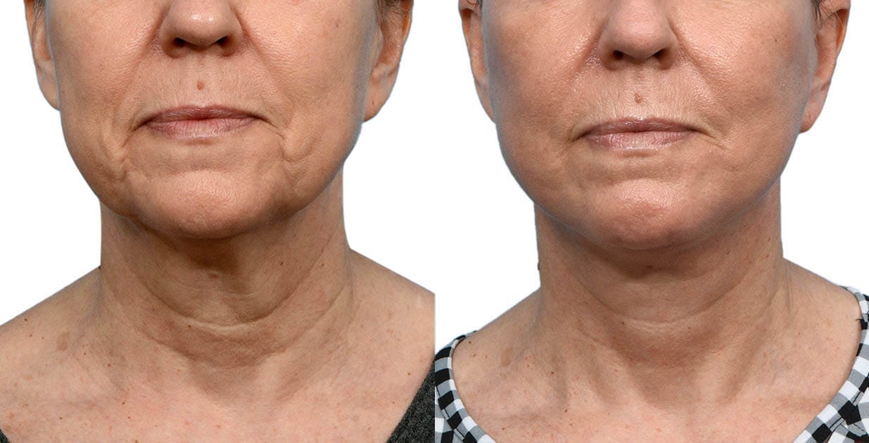Facelift before and after