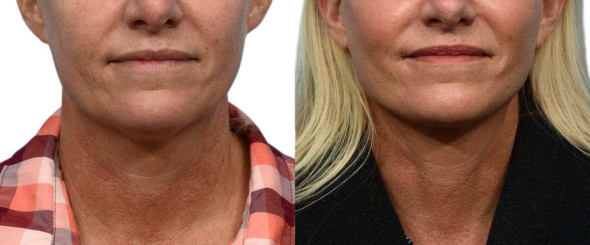 Facelift before and after