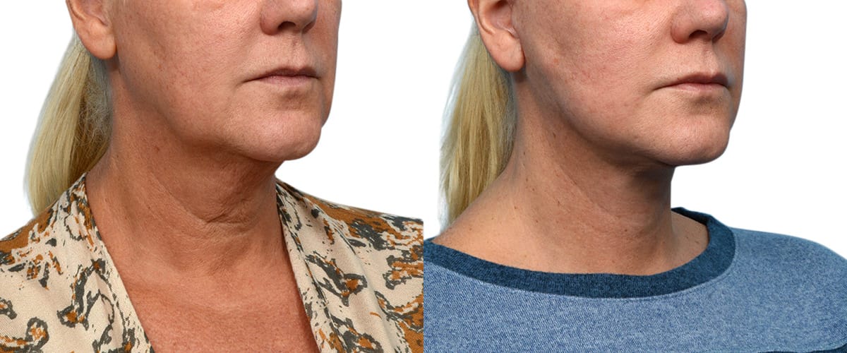 Facelift Before & After Gallery - Patient 210287 - Image 3