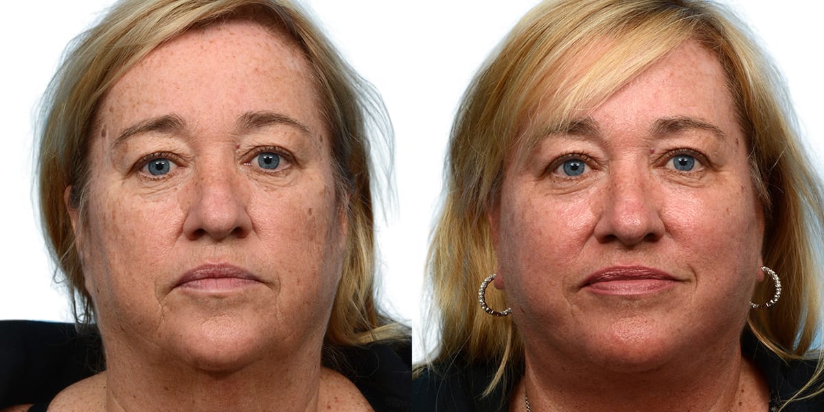 Facelift before and after